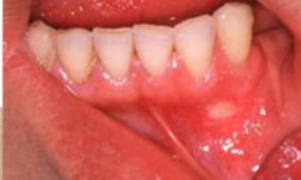 رابطه شیمی درمانی و زخم های دهانی