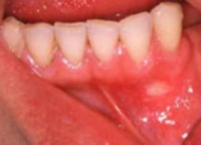 رابطه شیمی درمانی و زخم های دهانی